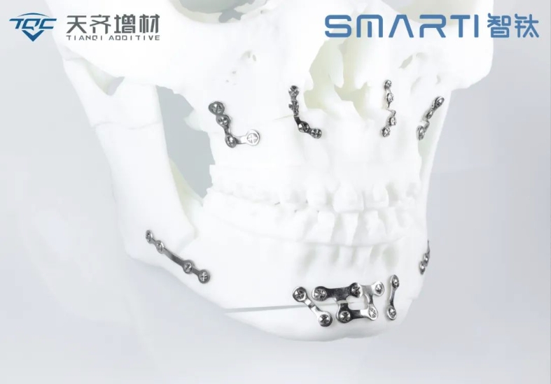 智钛3D打印患者匹配式颌面接骨板： 创新引领口腔颌面外科新时代